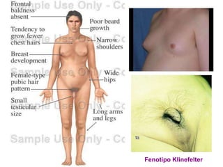 Fenotipo Klinefelter
 