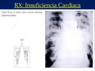 RX: Insuficiencia Cardiaca 