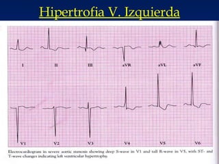 Hipertrofia V. Izquierda 