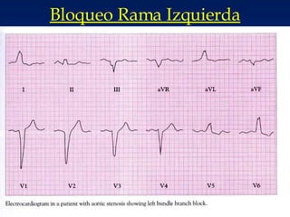 Bloqueo Rama Izquierda 
