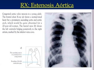 RX: Estenosis Aórtica 