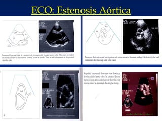 ECO: Estenosis Aórtica 