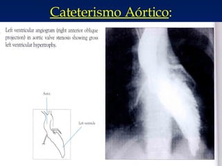 Cateterismo Aórtico : 