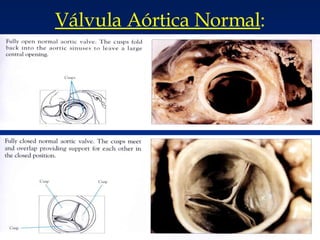Válvula Aórtica Normal : 