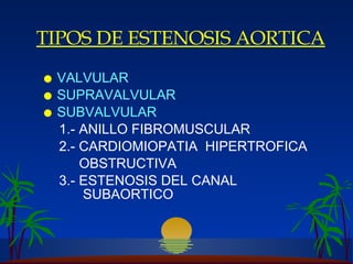 TIPOS DE ESTENOSIS AORTICA VALVULAR SUPRAVALVULAR SUBVALVULAR 1.- ANILLO FIBROMUSCULAR 2.- C ARDIOMIOPATIA  H IPERTROFICA OBSTRUCTIVA 3.- ESTENOSIS DEL CANAL   SUBAORTICO 