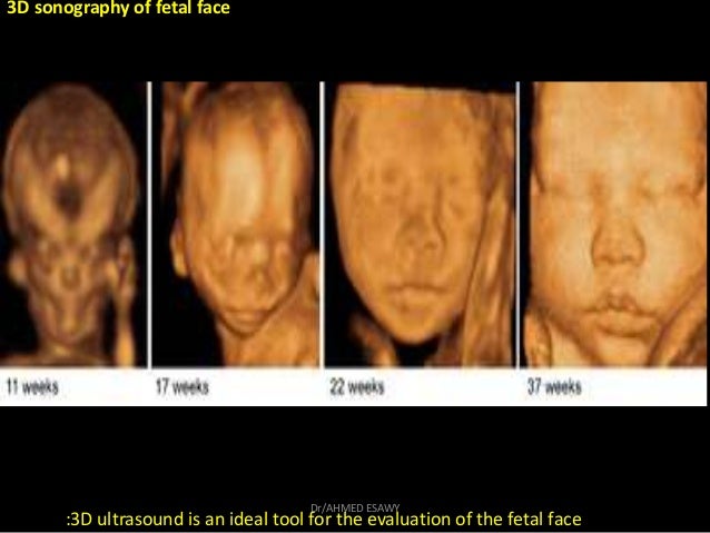 5 Fetal Face Ultrasound Dr Ahmed Esawy 5 Fetal Face Ultrasound Dr Ahmed Esawy