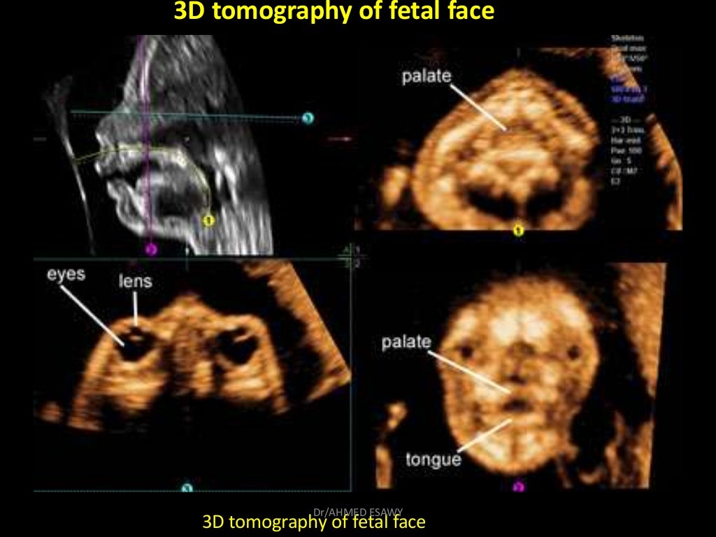 5Fetal face ultrasound Dr Ahmed Esawy