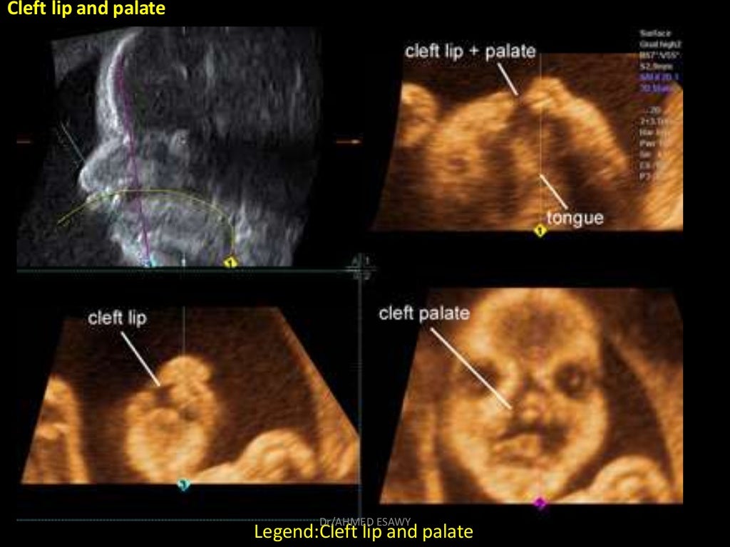 5Fetal face ultrasound Dr Ahmed Esawy