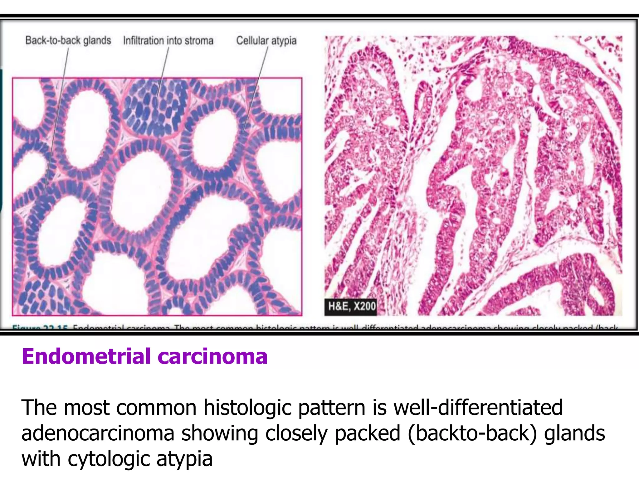 ENDOMETRIAL CARCINOMA & OVARIAN TUMOURS | PPTX