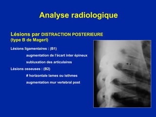 Lésions par DISTRACTION POSTERIEURE
(type B de Magerl)
Lésions ligamentaires : (B1)
augmentation de l’écart inter épineux
subluxation des articulaires
Lésions osseuses : (B2)
# horizontale lames ou isthmes
augmentation mur vertebral post
Analyse radiologique
 