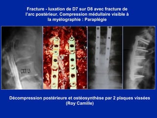 Décompression postérieure et ostéosynthèse par 2 plaques vissées
(Roy Camille)
Fracture - luxation de D7 sur D8 avec fracture de
l’arc postérieur. Compression médullaire visible à
la myélographie : Paraplégie
 