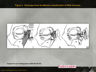 Figure 3. Drawings show the Manson classification of NOE fractures.




          Hopper R A et al. Radiographics 2006;26:783-793



©2006 by Radiological Society of North America
 
