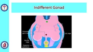Indifferent Gonad
 