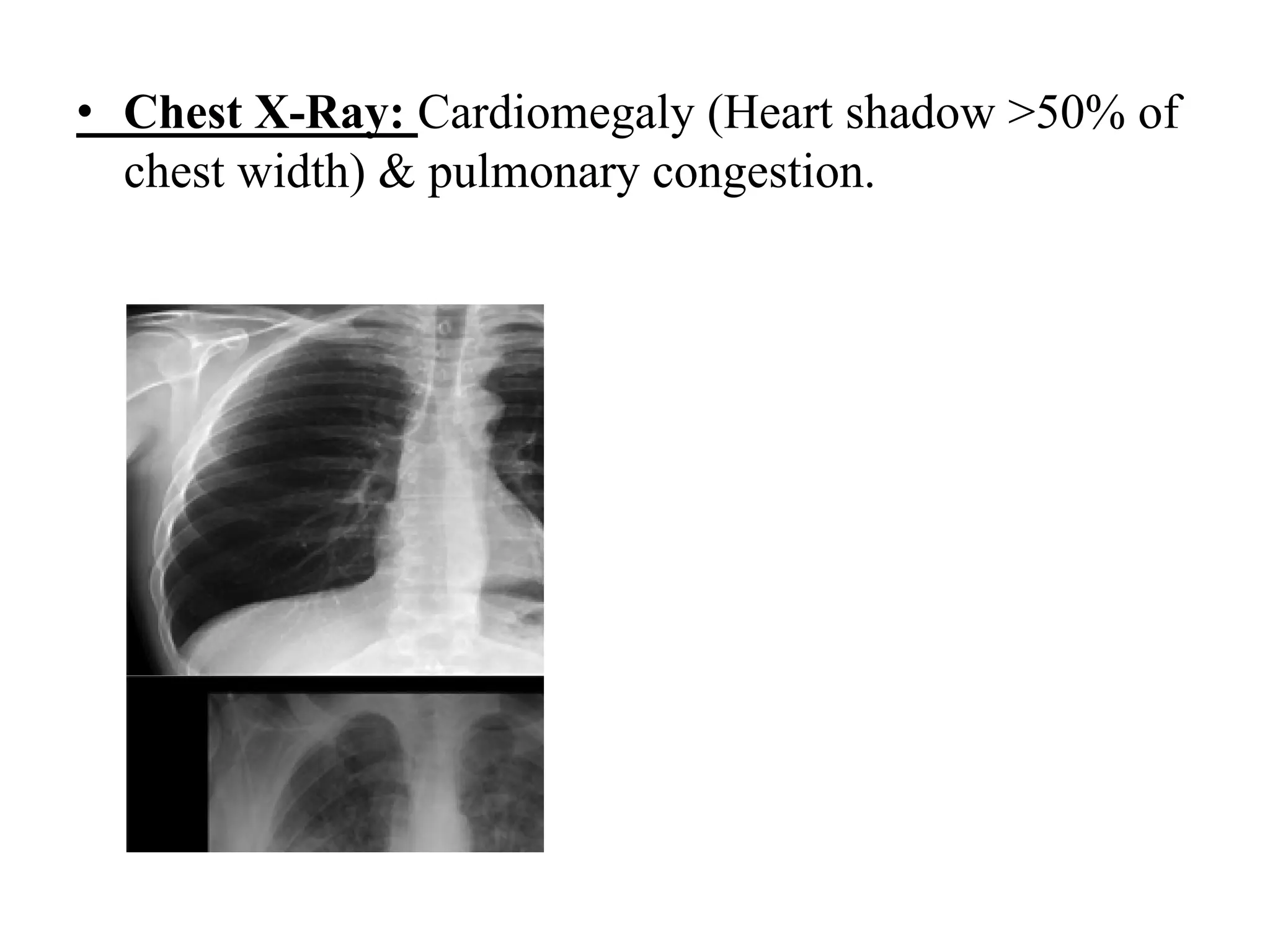 • Chest X-Ray: Cardiomegaly (Heart shadow >50% of
chest width) & pulmonary congestion.
 