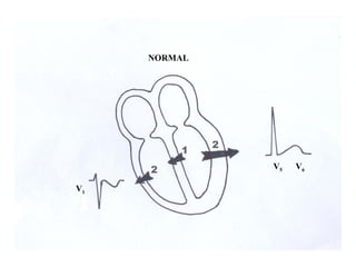 V1
V5 V6
NORMAL
1
2
2
 