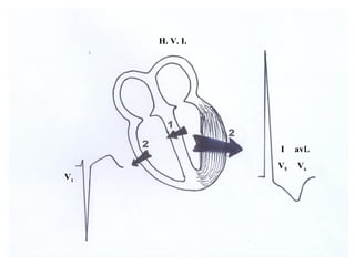 H. V. I.
V1
V5 V6
1
2
2
I avL
 
