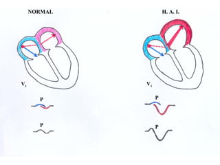 V1 V1
H. A. I.NORMAL
P P
P P
 
