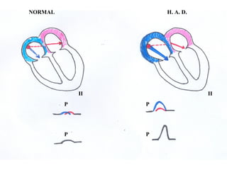 II II
H. A. D.NORMAL
P P
P P
 