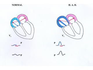 H. A. D.NORMAL
P P
P P
V1 V1
 