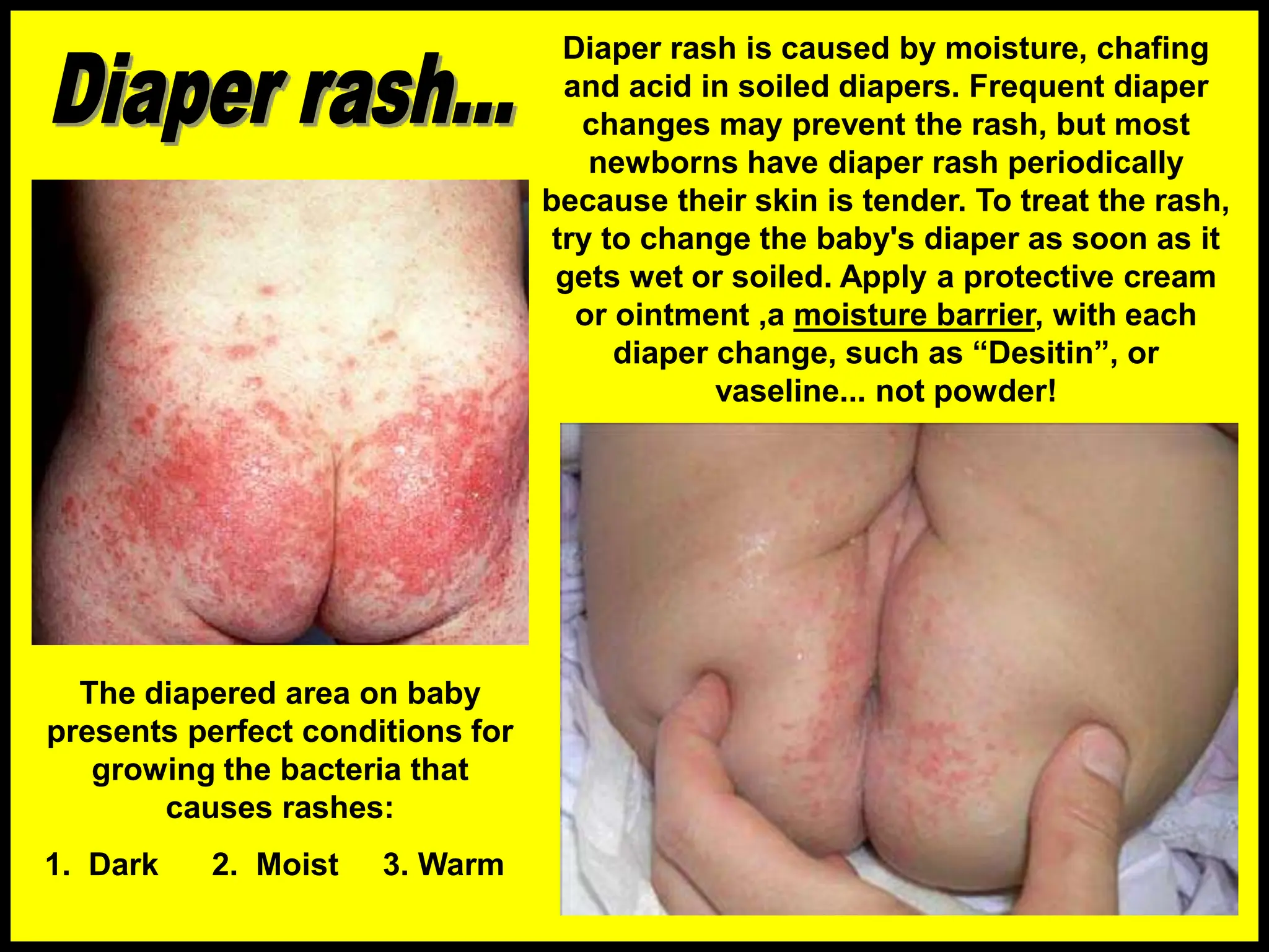 Diaper rash is caused by moisture, chafing
and acid in soiled diapers. Frequent diaper
changes may prevent the rash, but most
newborns have diaper rash periodically
because their skin is tender. To treat the rash,
try to change the baby's diaper as soon as it
gets wet or soiled. Apply a protective cream
or ointment ,a moisture barrier, with each
diaper change, such as “Desitin”, or
vaseline... not powder!
The diapered area on baby
presents perfect conditions for
growing the bacteria that
causes rashes:
1. Dark 2. Moist 3. Warm
 