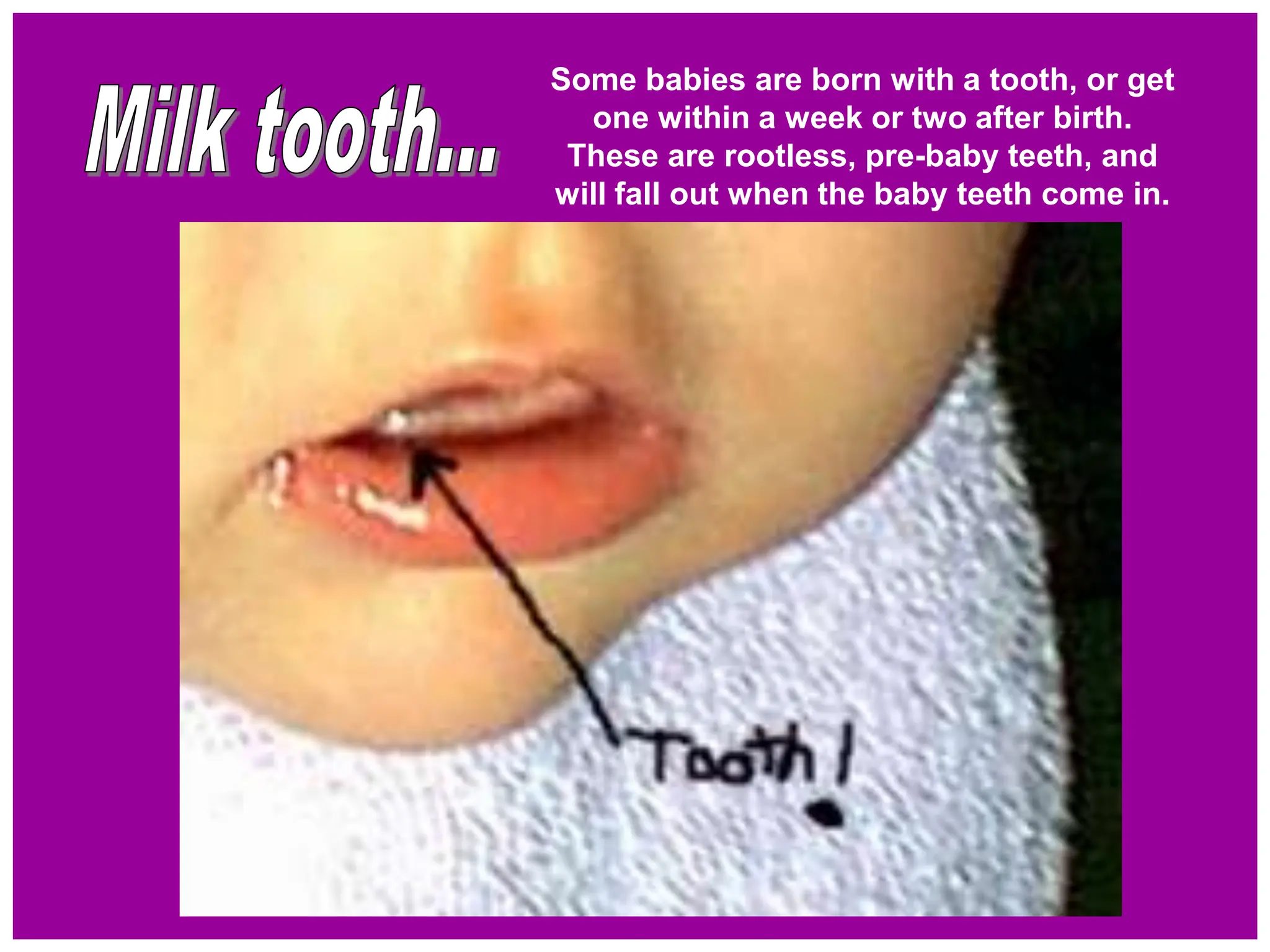 Some babies are born with a tooth, or get
one within a week or two after birth.
These are rootless, pre-baby teeth, and
will fall out when the baby teeth come in.
 