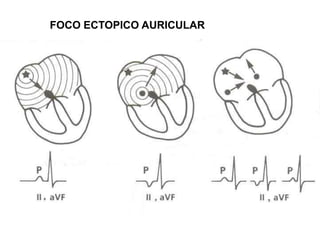 FOCO ECTOPICO AURICULAR
 