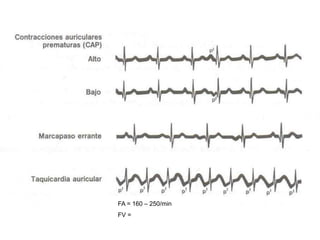 FA = 160 – 250/min
FV =
 