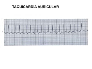 TAQUICARDIA AURICULAR
 