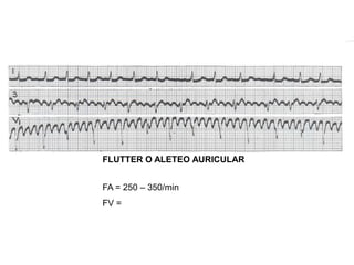 FLUTTER O ALETEO AURICULAR
FA = 250 – 350/min
FV =
 