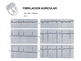 FIBRILACION AURICULAR
FA = 350 – 700/min
FV =
 