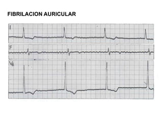FIBRILACION AURICULAR
 