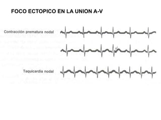 FOCO ECTOPICO EN LA UNION A-V
 
