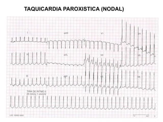 TAQUICARDIA PAROXISTICA (NODAL)
 