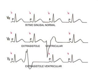 RITMO SINUSAL NORMAL
EXTRASISTOLE VENTRICULAR
EXTRASISTOLE VENTRICULAR
 
