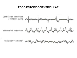 FOCO ECTOPICO VENTRICULAR
 