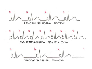 RITMO SINUSAL NORMAL FC=75/min
TAQUICARDIA SINUSAL FC = 101 - 160/min
BRADICARDIA SINUSAL FC < 60/min
 