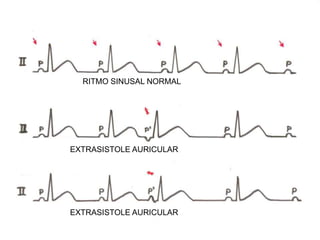 RITMO SINUSAL NORMAL
EXTRASISTOLE AURICULAR
EXTRASISTOLE AURICULAR
 