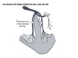 BLOQUEO DE RAMA DERECHA DEL HAZ DE HIS
 