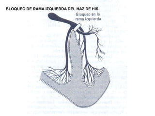 BLOQUEO DE RAMA IZQUIERDA DEL HAZ DE HIS
 