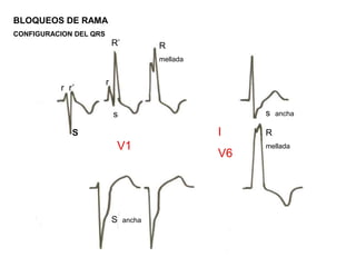 BLOQUEOS DE RAMA
CONFIGURACION DEL QRS
r r’
S
r
s
R’ R
mellada
s ancha
S ancha
R
melladaV1
I
V6
 