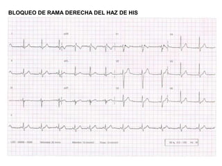 BLOQUEO DE RAMA DERECHA DEL HAZ DE HIS
 