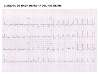BLOQUEO DE RAMA DERECHA DEL HAZ DE HIS
 