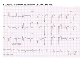 BLOQUEO DE RAMA IZQUIERDA DEL HAZ DE HIS
 
