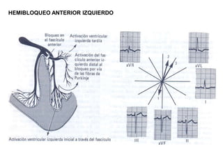 HEMIBLOQUEO ANTERIOR IZQUIERDO
 