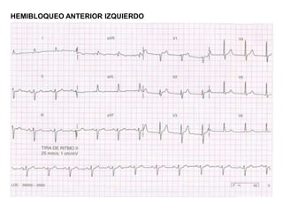 HEMIBLOQUEO ANTERIOR IZQUIERDO
 