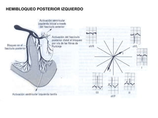 HEMIBLOQUEO POSTERIOR IZQUIERDO
 