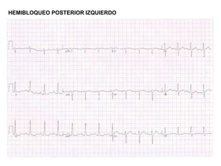 HEMIBLOQUEO POSTERIOR IZQUIERDO
 