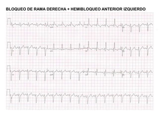 BLOQUEO DE RAMA DERECHA + HEMIBLOQUEO ANTERIOR IZQUIERDO
 
