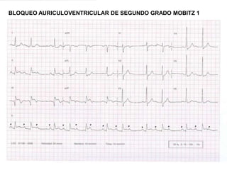 BLOQUEO AURICULOVENTRICULAR DE SEGUNDO GRADO MOBITZ 1
 
