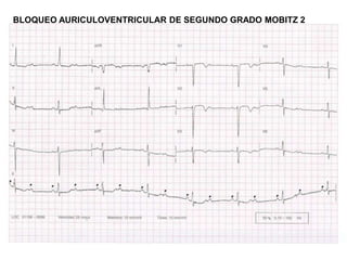 BLOQUEO AURICULOVENTRICULAR DE SEGUNDO GRADO MOBITZ 2
 